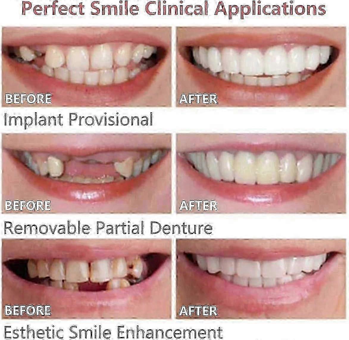 Instant Smile Veneers Reusable Set