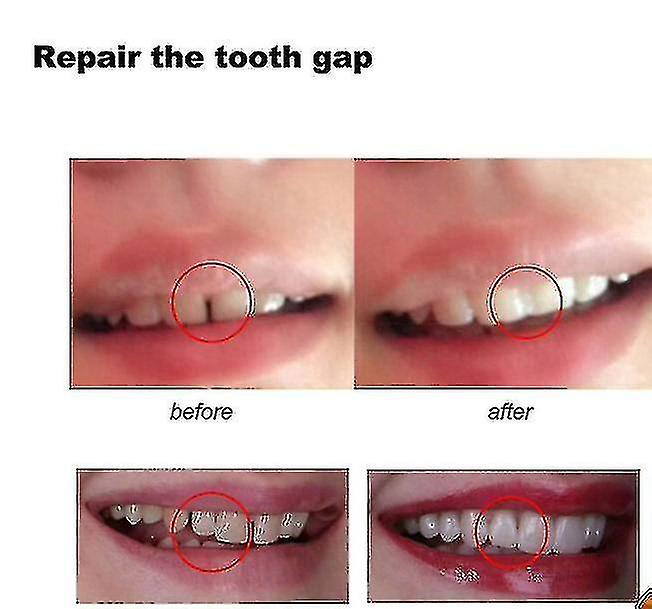 100g Teeth And Gap Falseteeth Solid Glue Resin Denture Adhesive Teeth Dentist Falseteeth Solid Glue Temporary