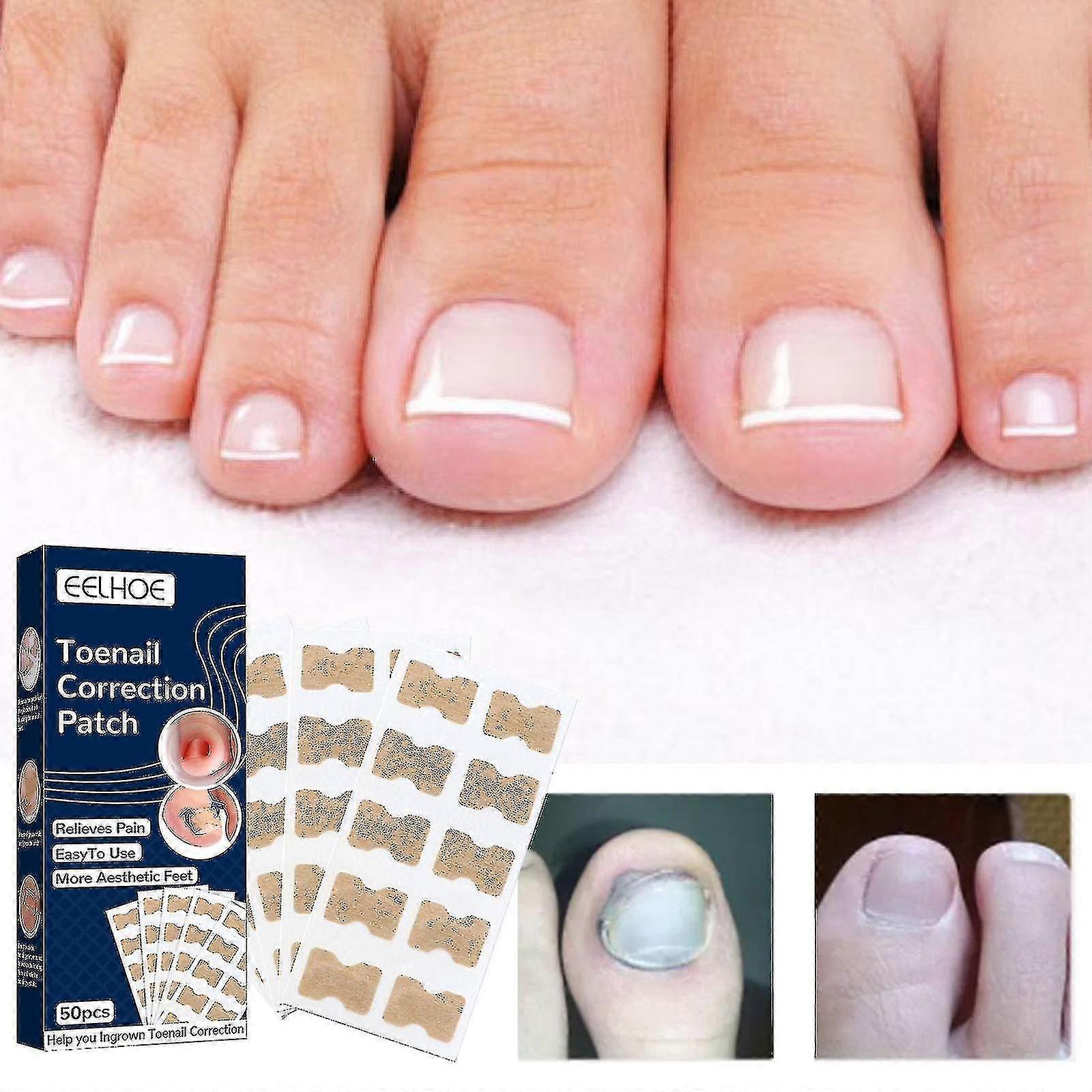 1pc Toenail Correction Stickers Manicure Orthopedic Stickers Embedded Nail Correction Toe Embedded Nail Repair Patch