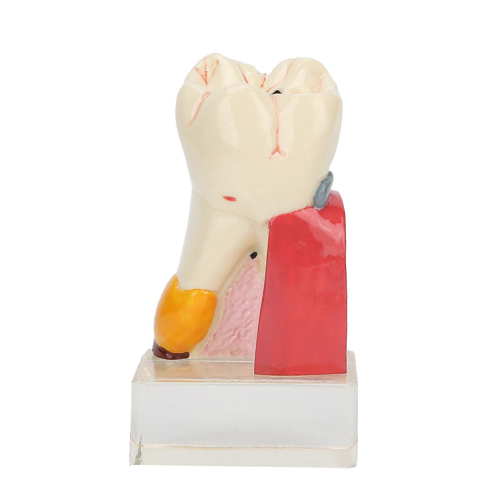Dental Teeth Model 6 Times Caries Teeth Models For Dentist Studying Teaching Demonstration