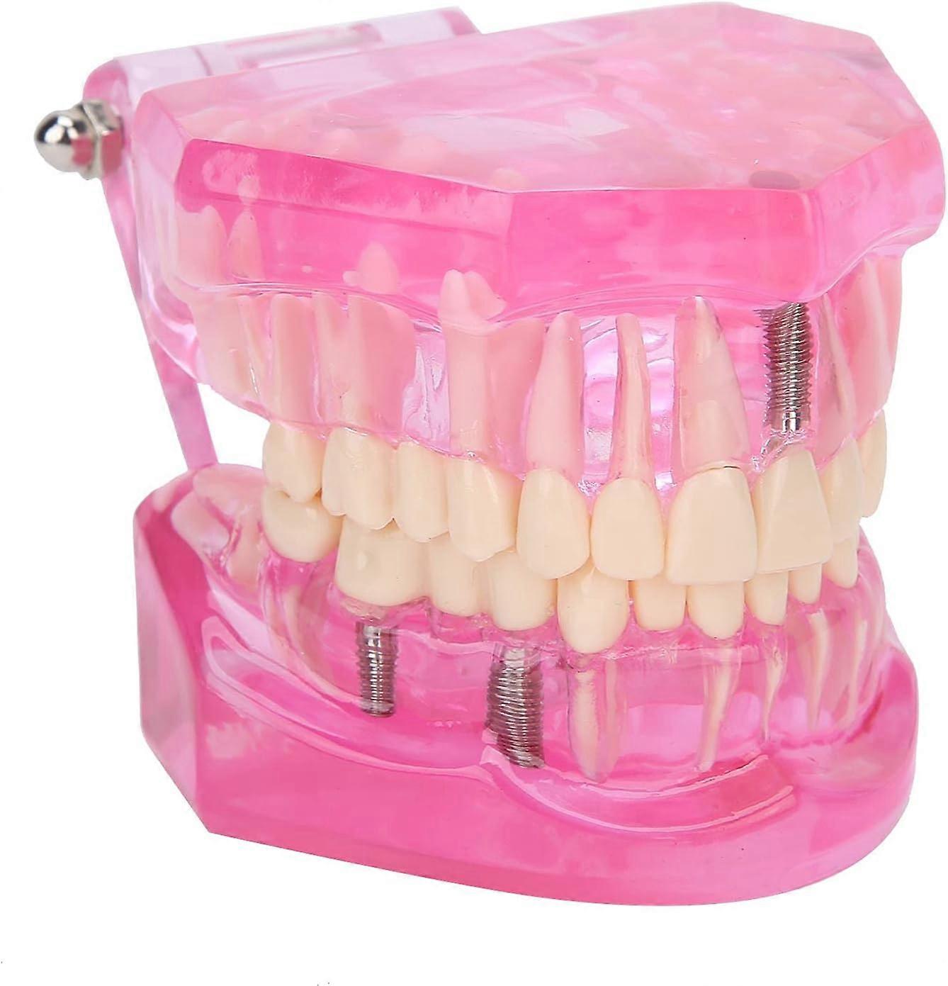 Tandmodel, voksentandsmodel klar til undervisning til undersøgelse