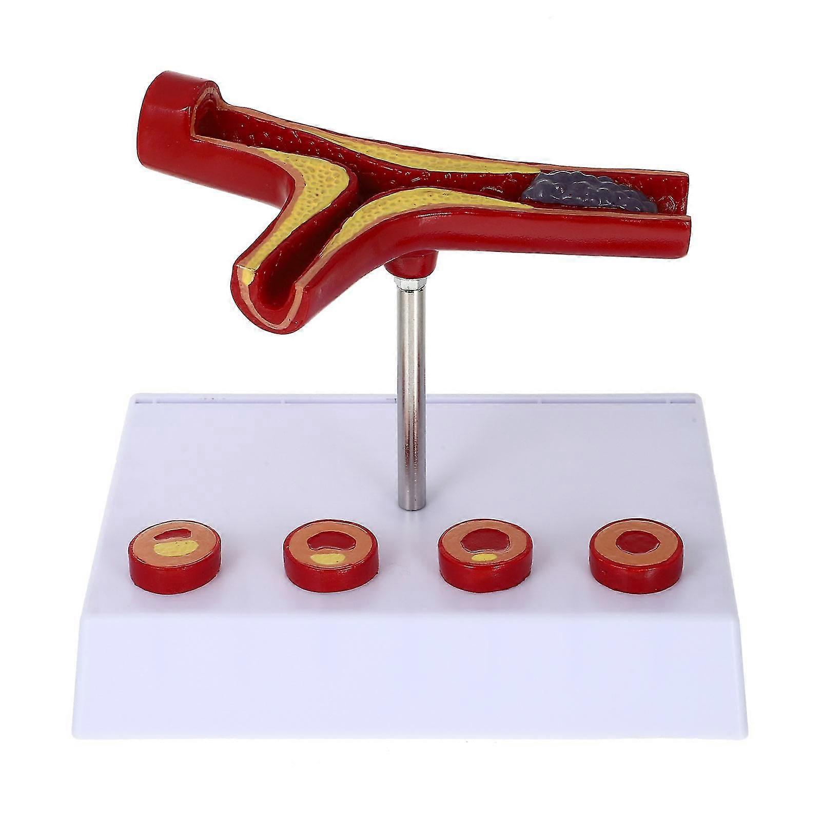 تصلب الشرايين النموذج الطبي نموذج تشريحي الأوعية الدموية نموذج القلب والأوعية الدموية