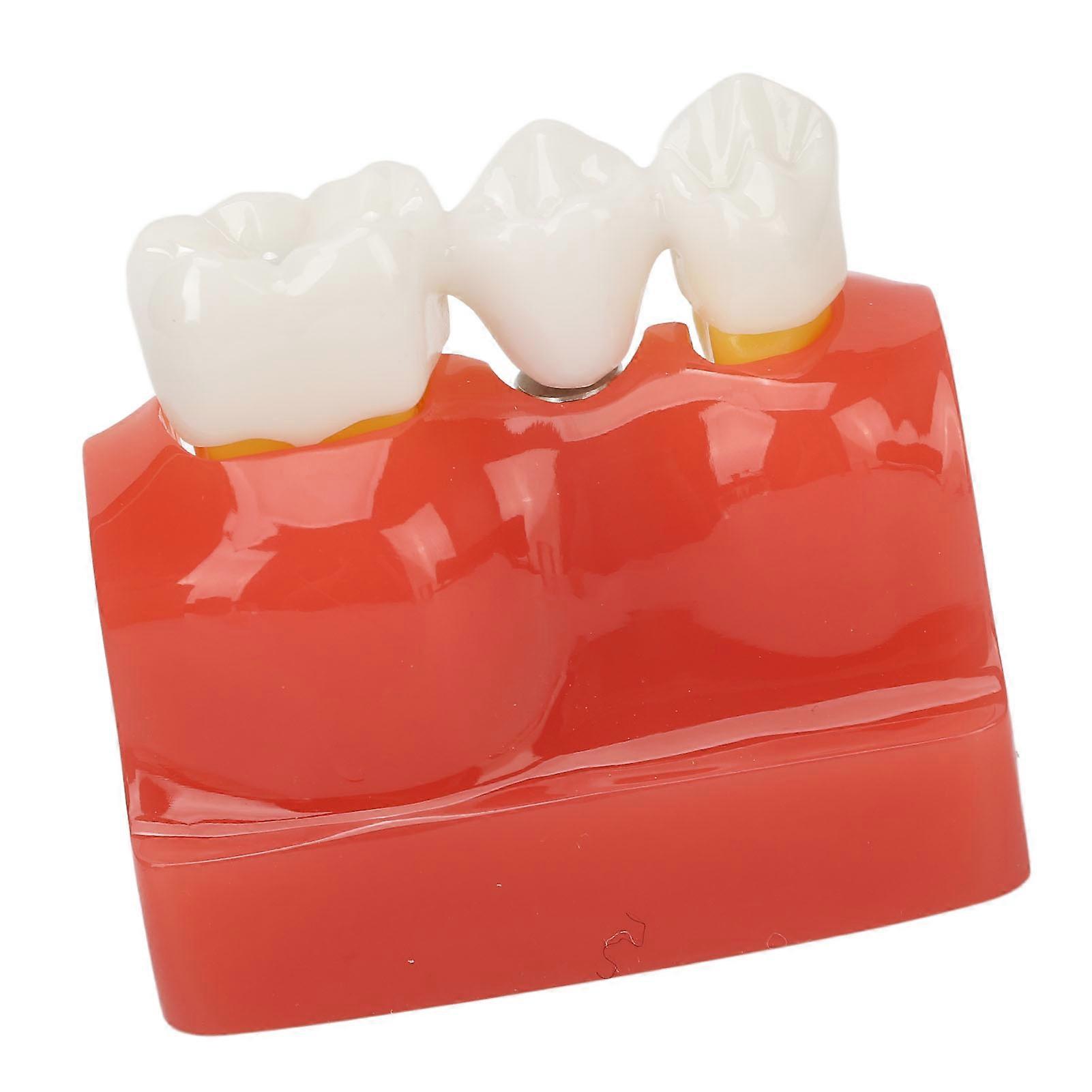 Dental Implant Analysis Crown Bridge Tooth Model Resin Demo Tool