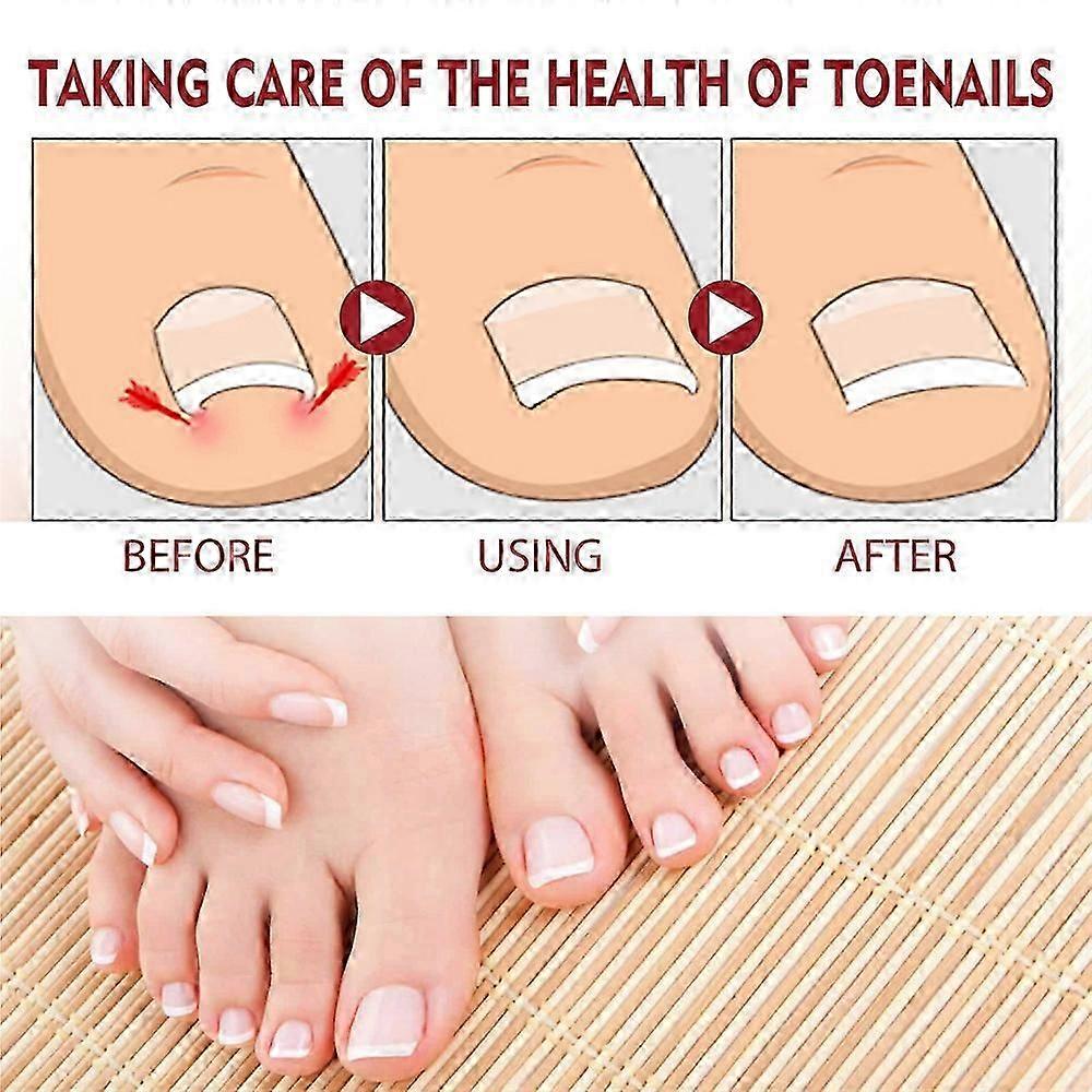 Nagelweichmacheröl zur Linderung von Paronychie 10ml