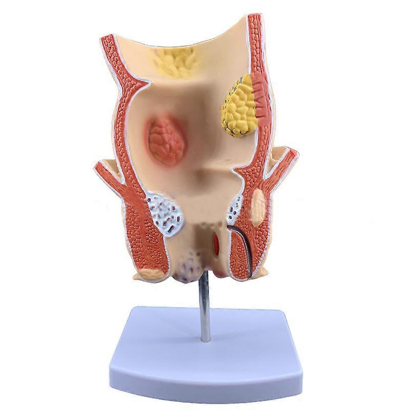 Simulated rectal pathology model Human body model medical teaching aids