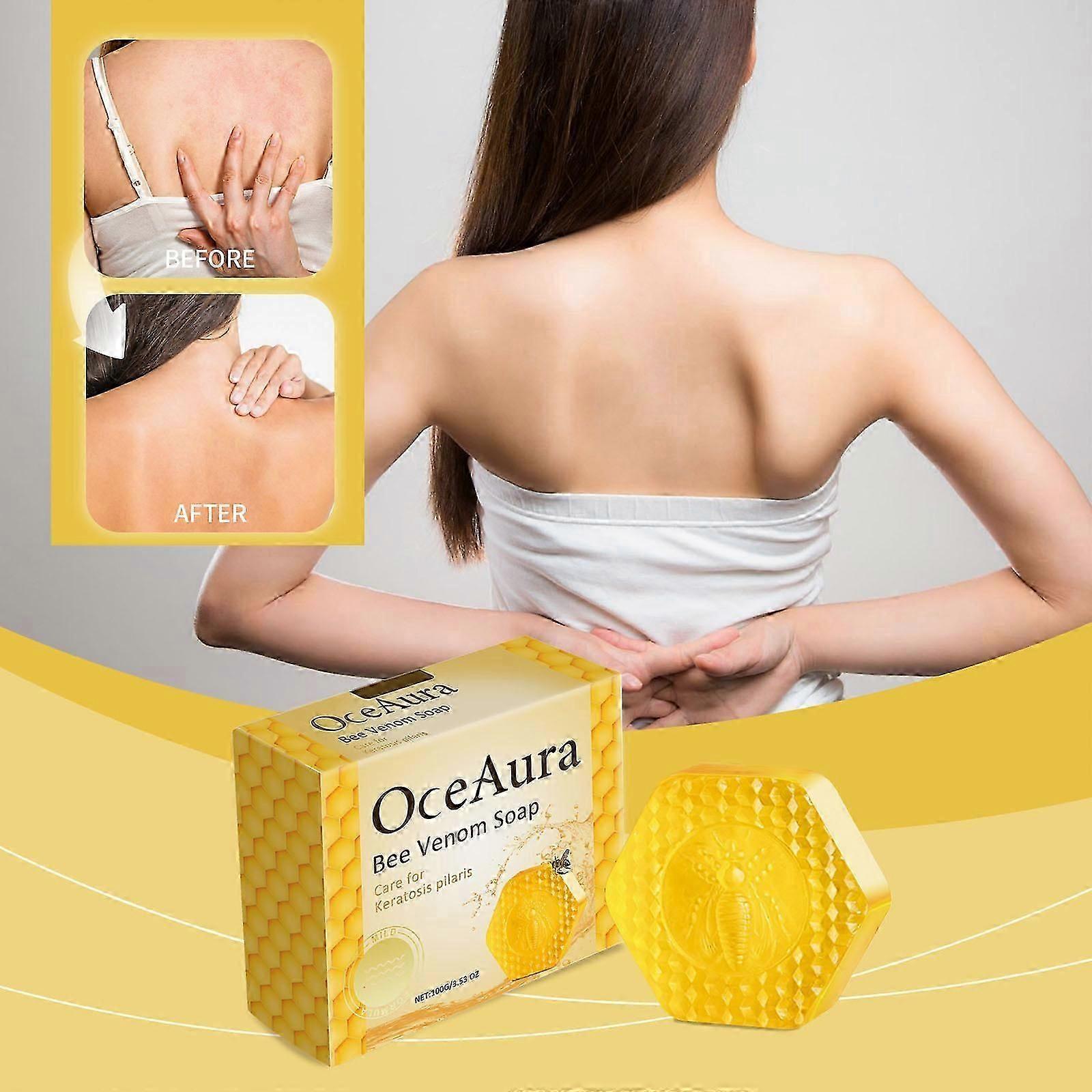 Bee Venomss For Lightening Spots The And Bathing Bar