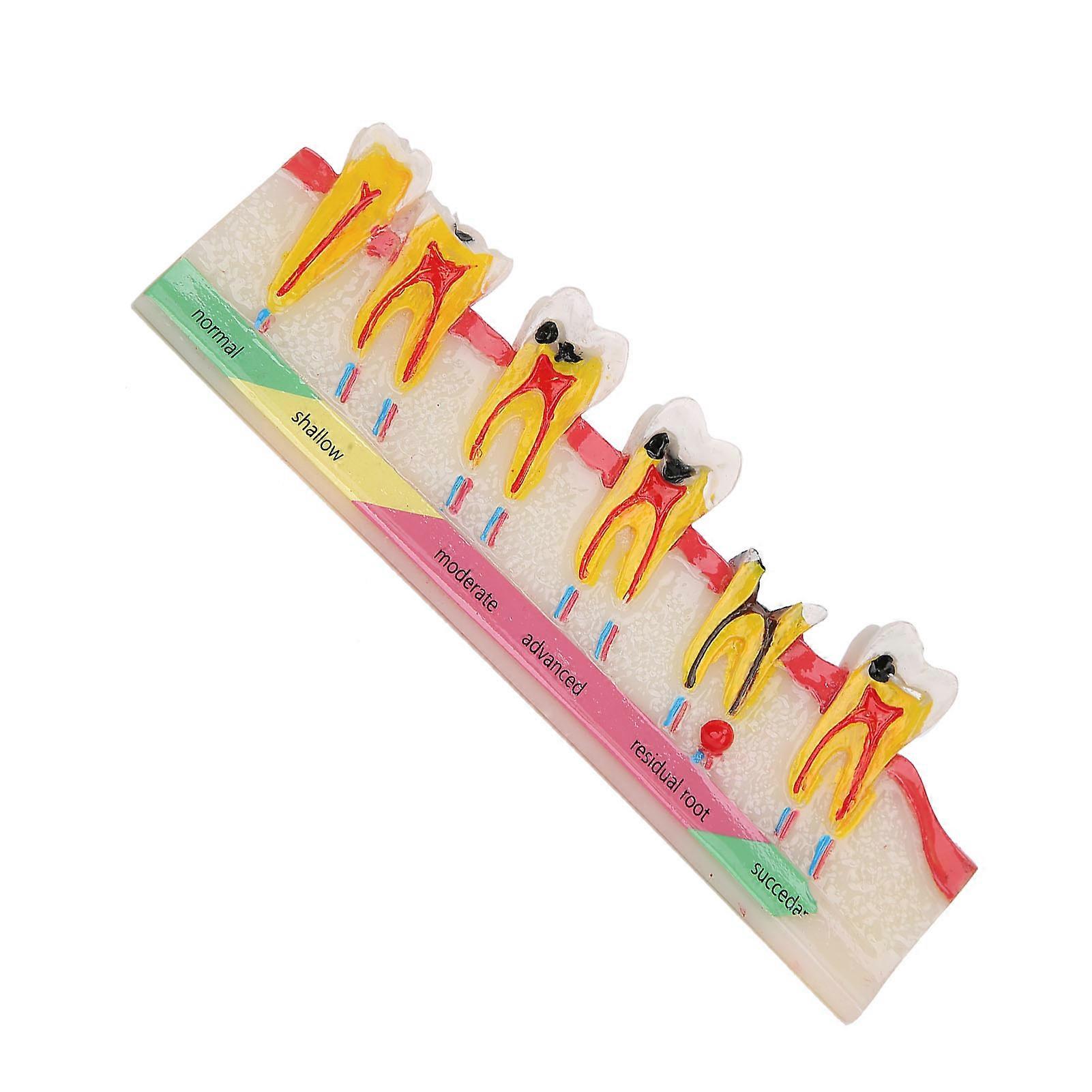 Dental Caries Developing Model Portable Decayed Teeth Model for Dental Teaching Study