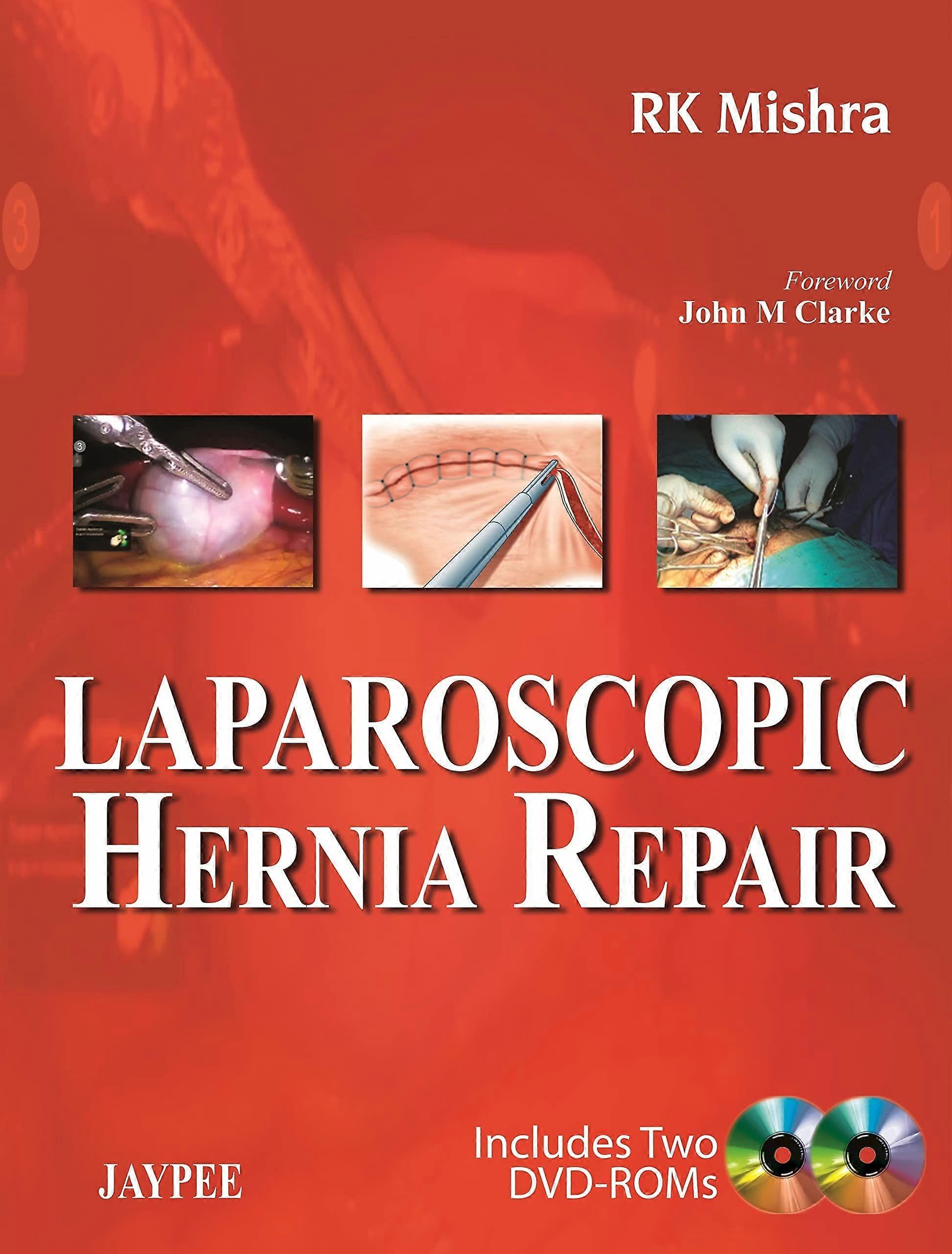 Laparoscopic hernia repair