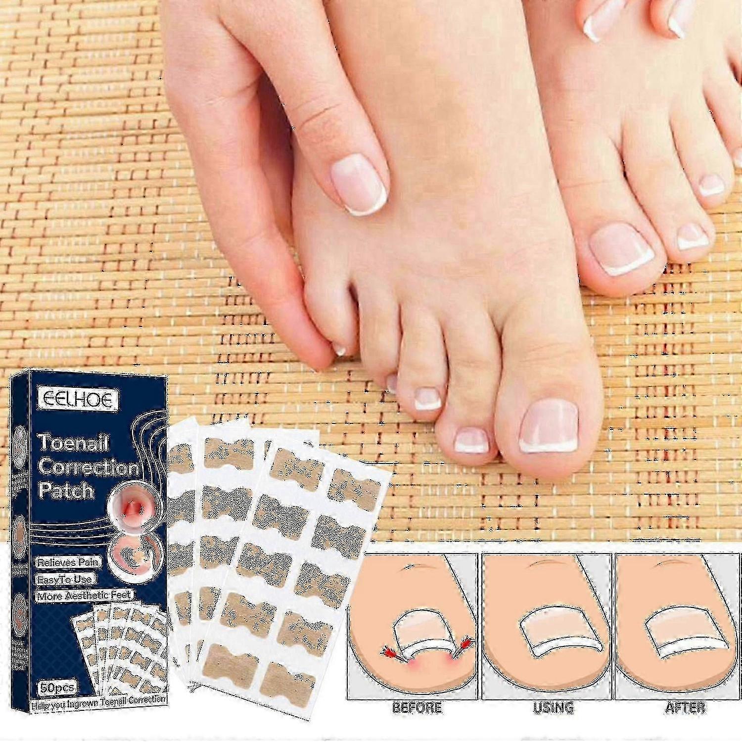 Eelhoe Toenail Correction Patch~A