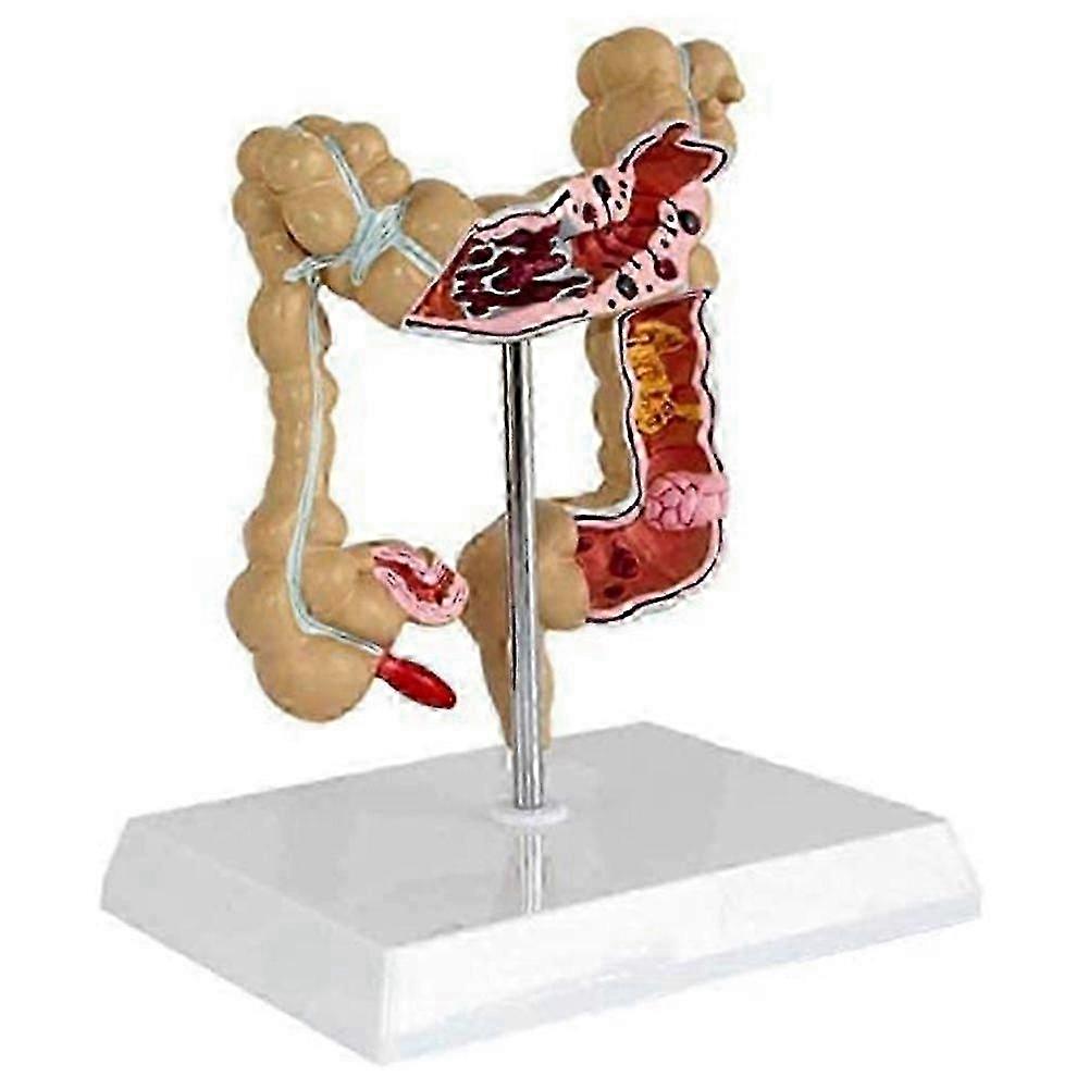 Pathological Colorectal Model Large Intestine Model Gastrointestinal Anatomical Model js