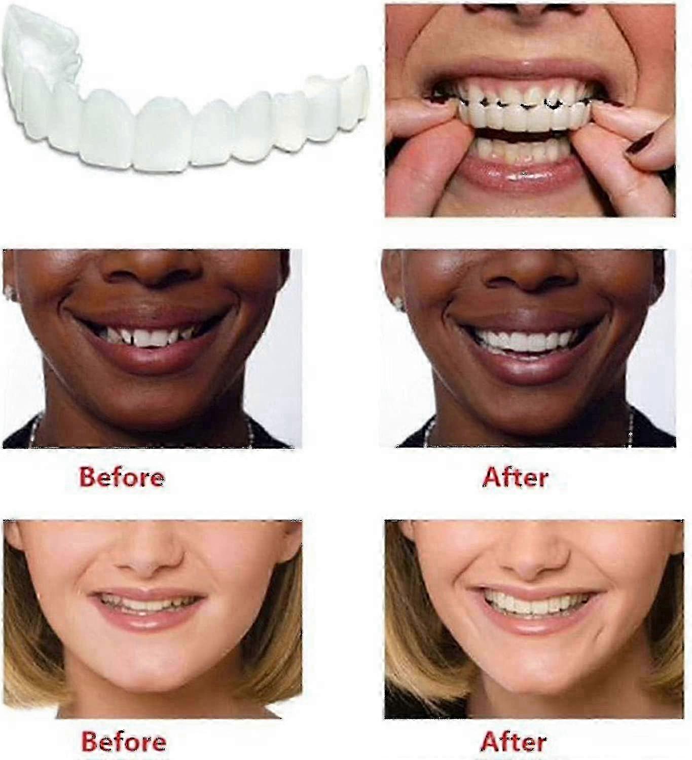 x Temporary Replacement Tooth Veneers Kit for Improved Smile