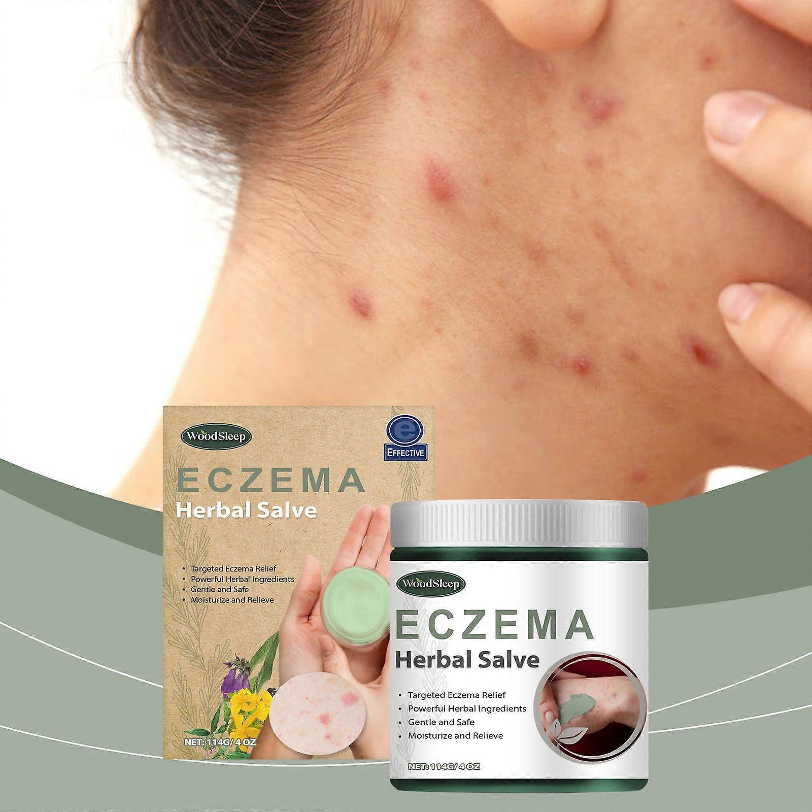 Eczema Herbal Salve - Targeted Relief with Natural Botanicals, Moisturizing & Gentle, Relieves Pruritus And Redness, Mild And Non-Irritating