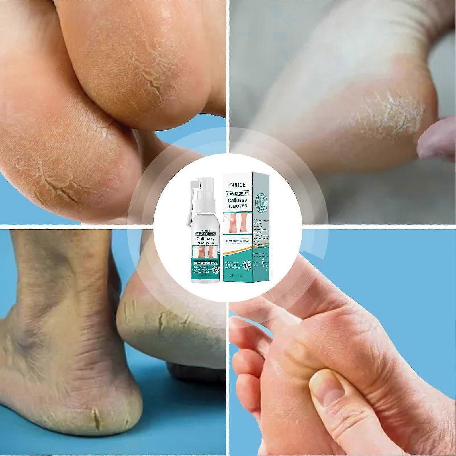 Omedelbar fotpeelingspray - Fotpeelingspray för att ta bort död hud - 20 ml Ta bort död hud, torr tåhud och förhårdnader snabbt