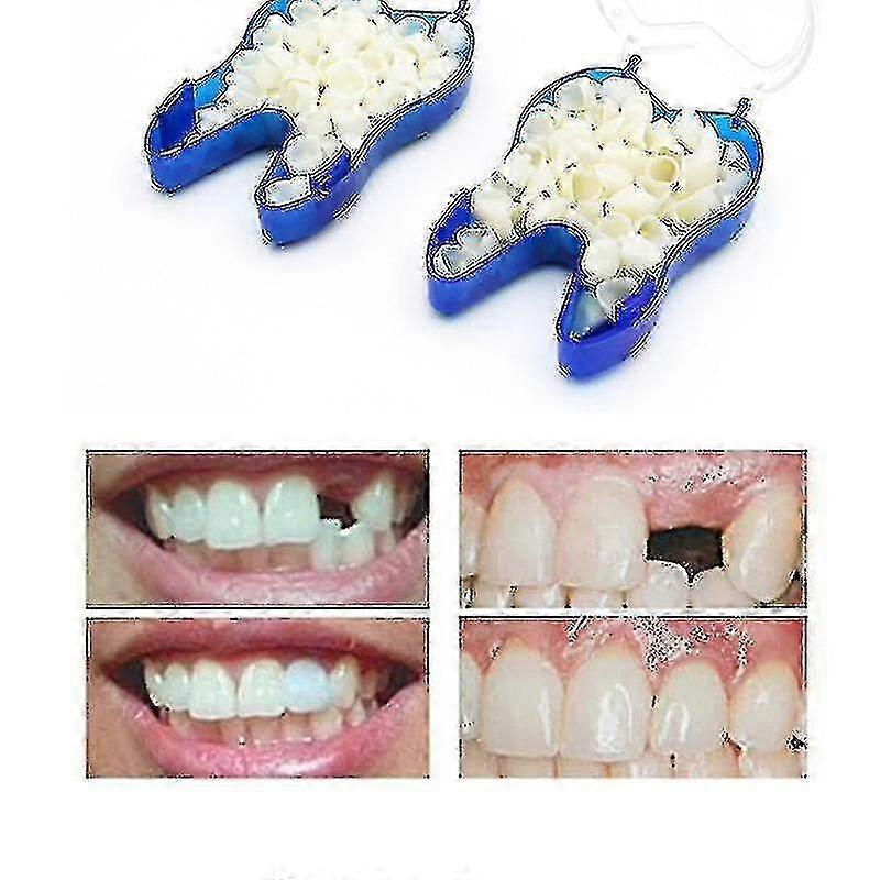 Temporary Denture Braces Occlude Upper Dentures Veneer Dentures Missing Teeth Broken Teeth