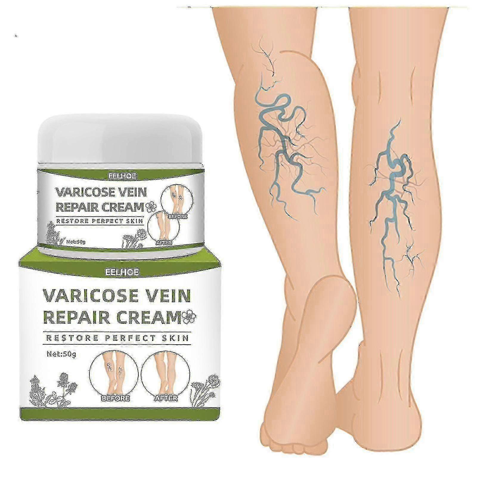 Åderbråckskräm, effektiv behandling av åderbråck och spindelvener