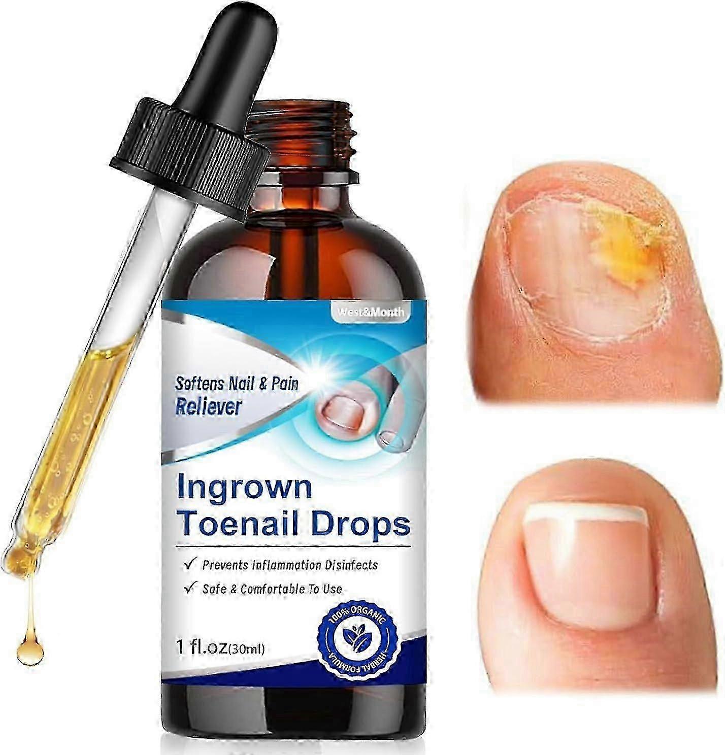 Titre optimisé pour les produits pour les ongles incarnés : « Huile et solution de traitement des ongles incarnés, soins des cuticules pour les ongles incarnés