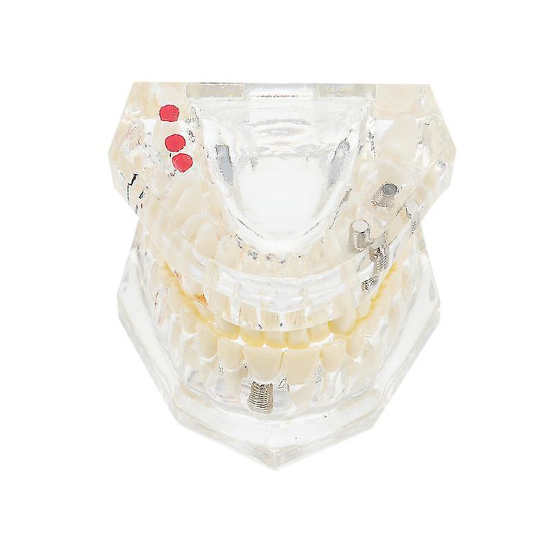 1pcs Dental Model