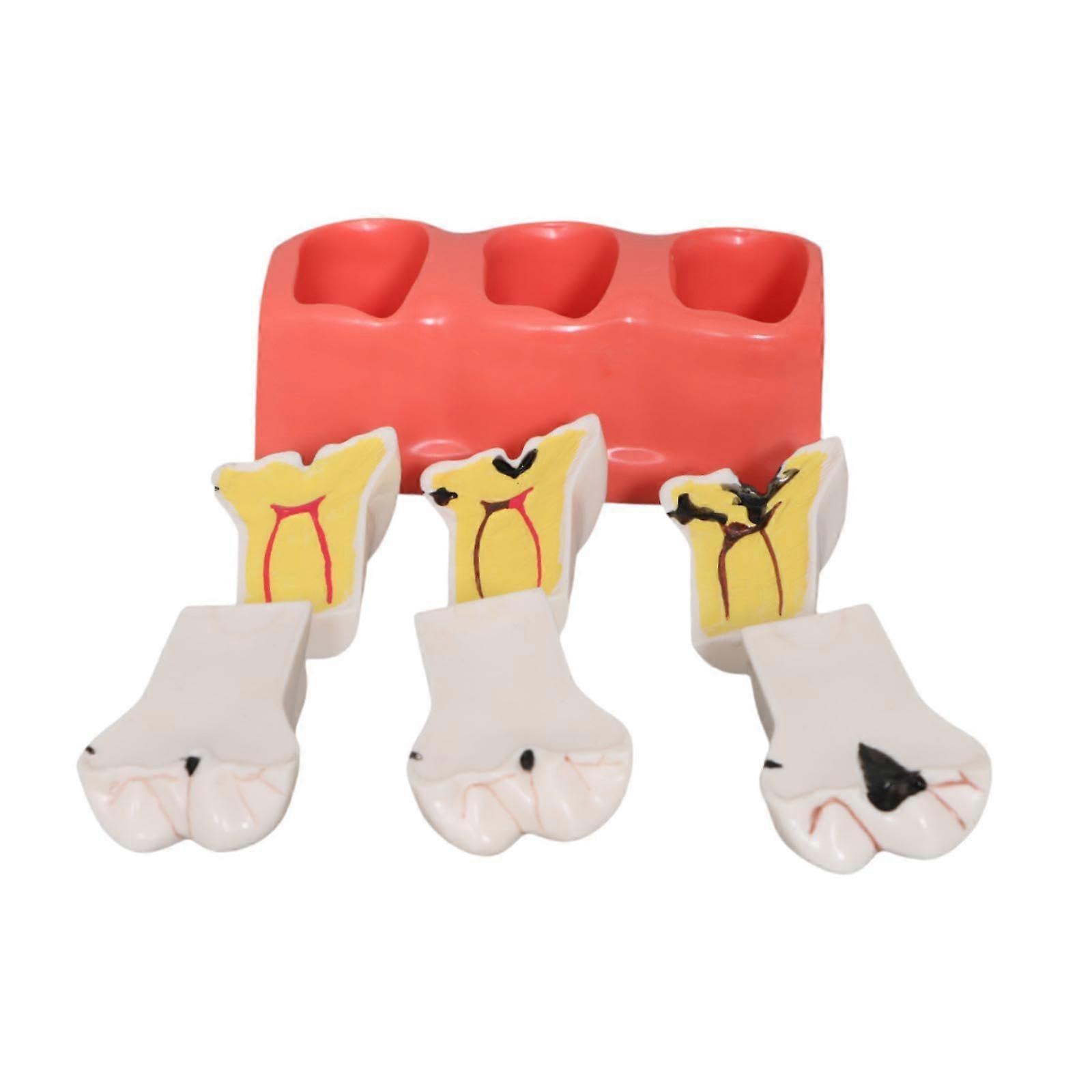 Dental Teaching Model with Realistic Decay Display, Flexible Rotation, Durable Resin Build