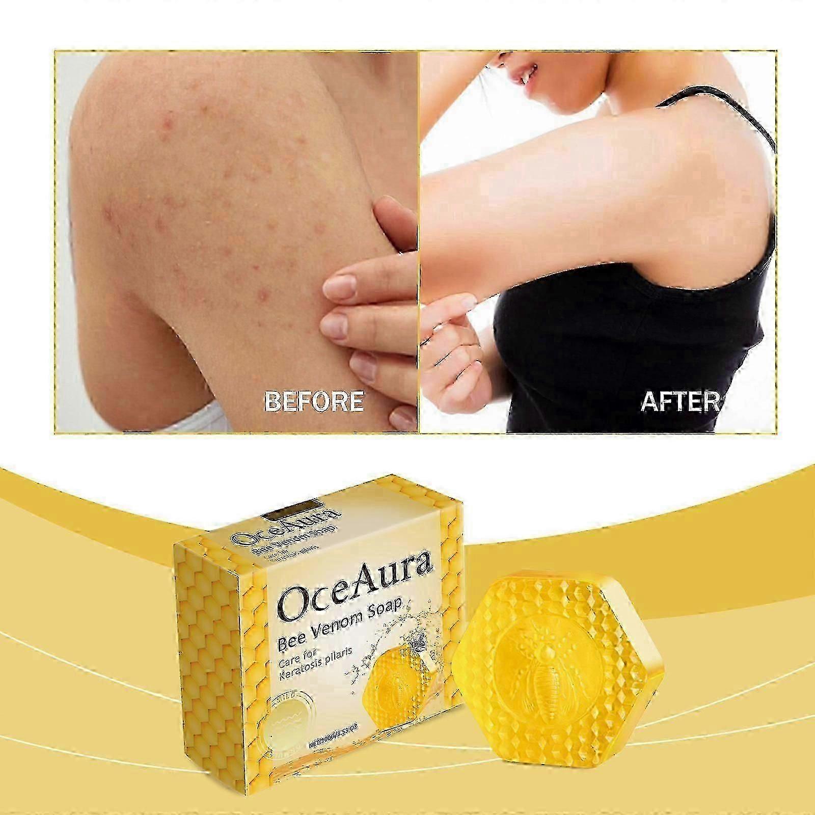 Σαπούνι Keratosis Pilaris Bee Venom, Σαπούνι Keratosis Pilaris, Σαπούνι Perratosis Pilaris, Bee Venom Σαπούνι θεραπείας Keratosis Pilaris
