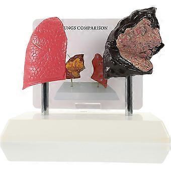 Smoking Lung Model and Normal Lung Comparison 3D Pulmonary Anatomy Medical Teaching Model for Physiology and Anatomy Education 7.87X7.08X5.51In