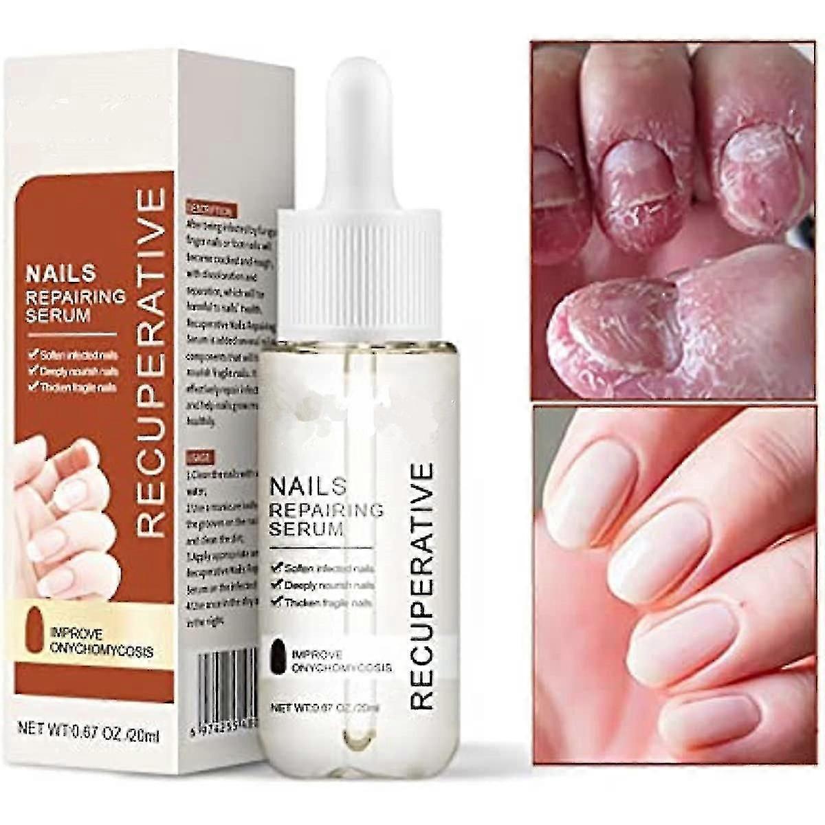 زيت الأظافر للبشرة ، علاج الأظافر الفطرية ، يرطب بشرة البشرة والأظافر ، علاج زيوت البشرة زيت الأظافر التالف