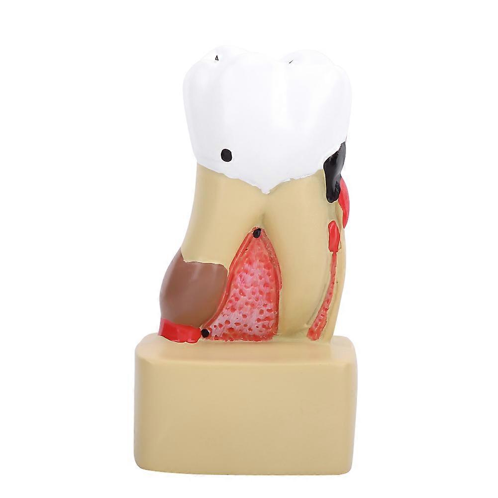 1pc Dental Comprehensive Pathological Disease Caries Study Teaching Tooth Model
