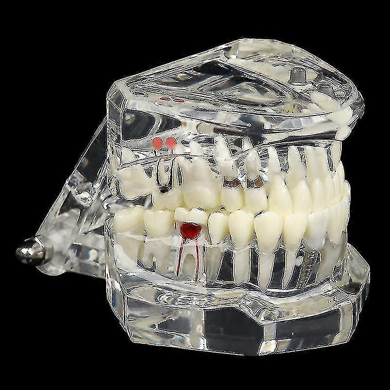Dental Model Teeth Implant Restoration Bridge Teaching For Study Tooth Science
