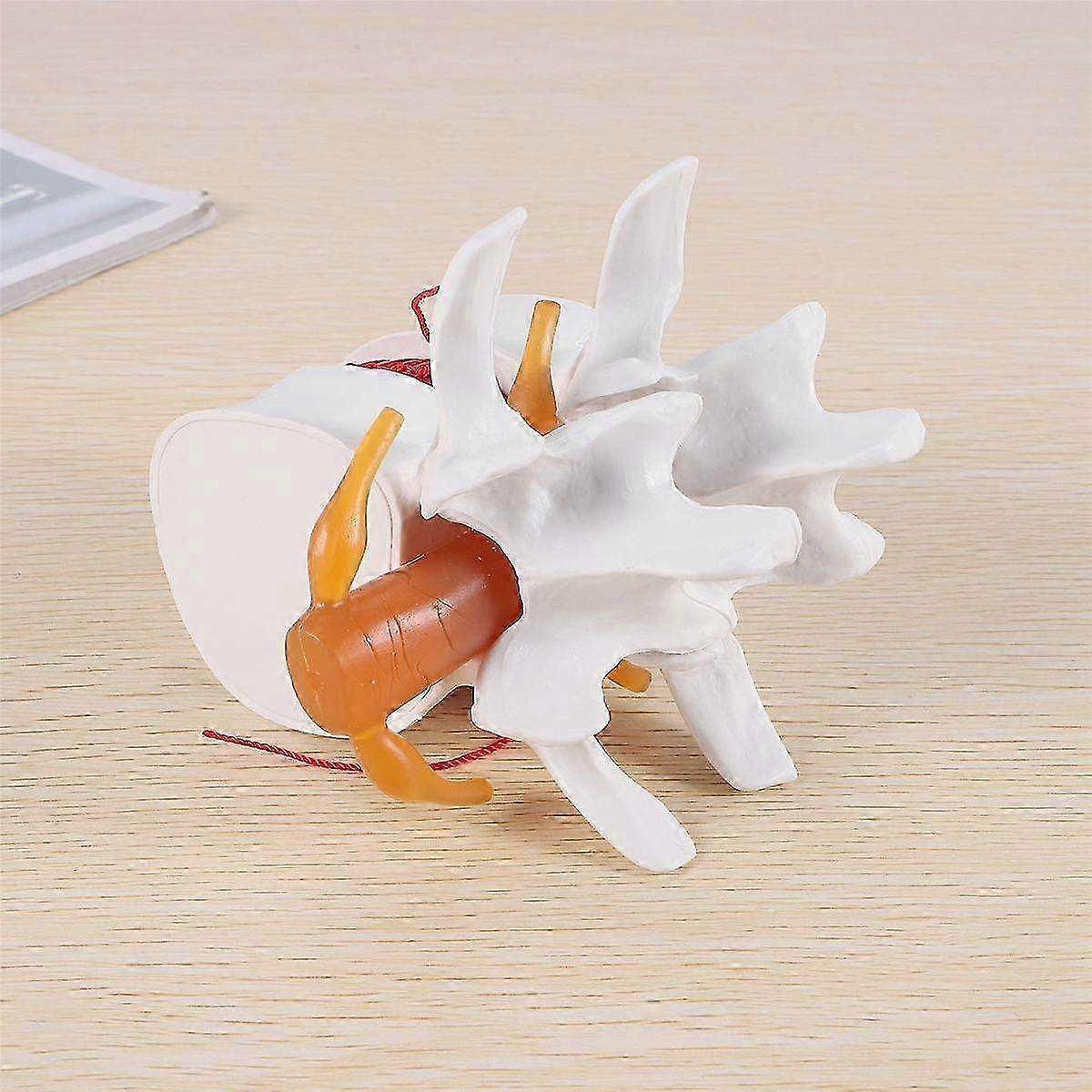 1:1.5 Human Lumbar Disc Herniation Demonstration Model of Lumbar Vertebral Spine Model for Human An