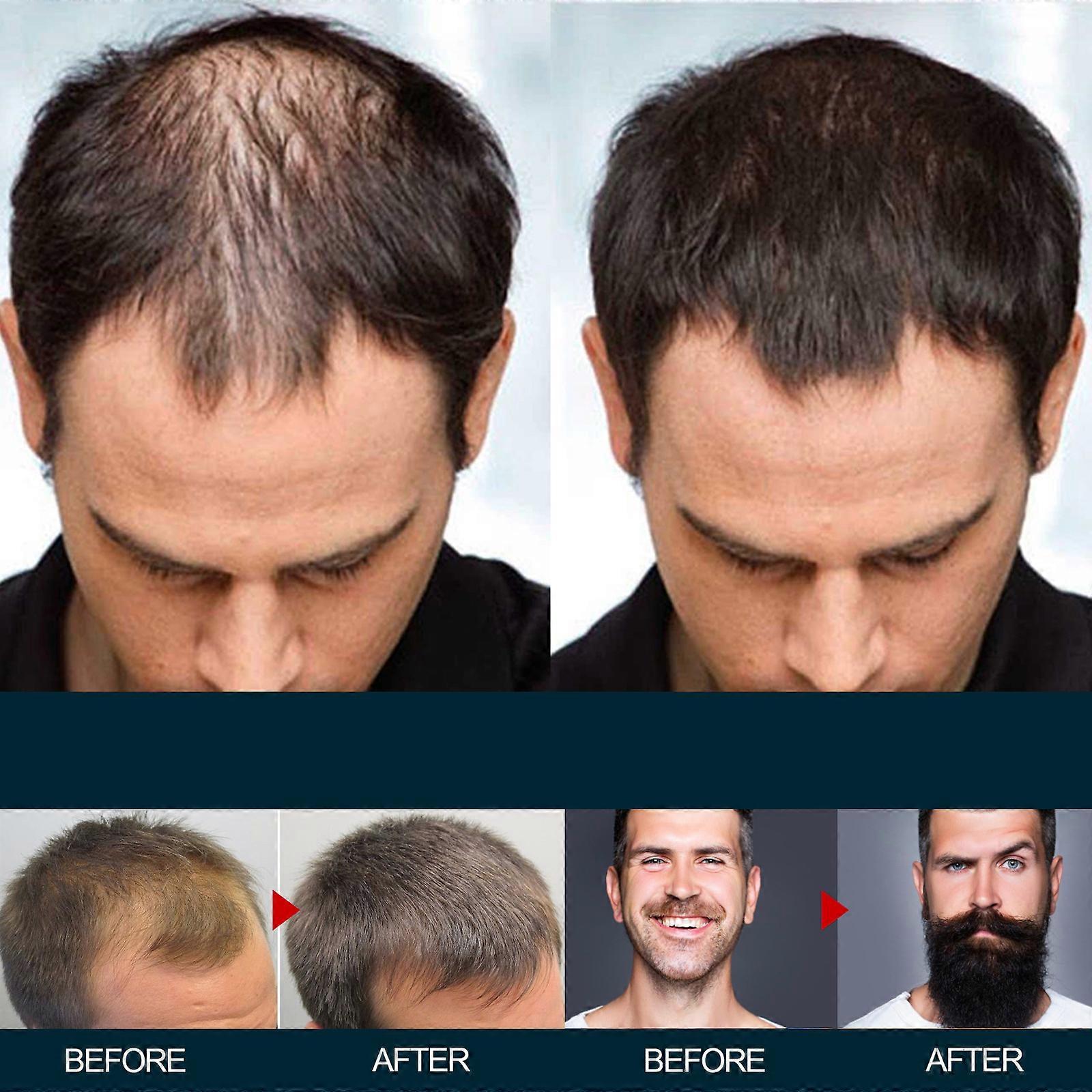 3 יחידות Minoxidil פתרונות מקומיים בעוצמה מוגברת לצמיחת שיער מחדש אצל גברים