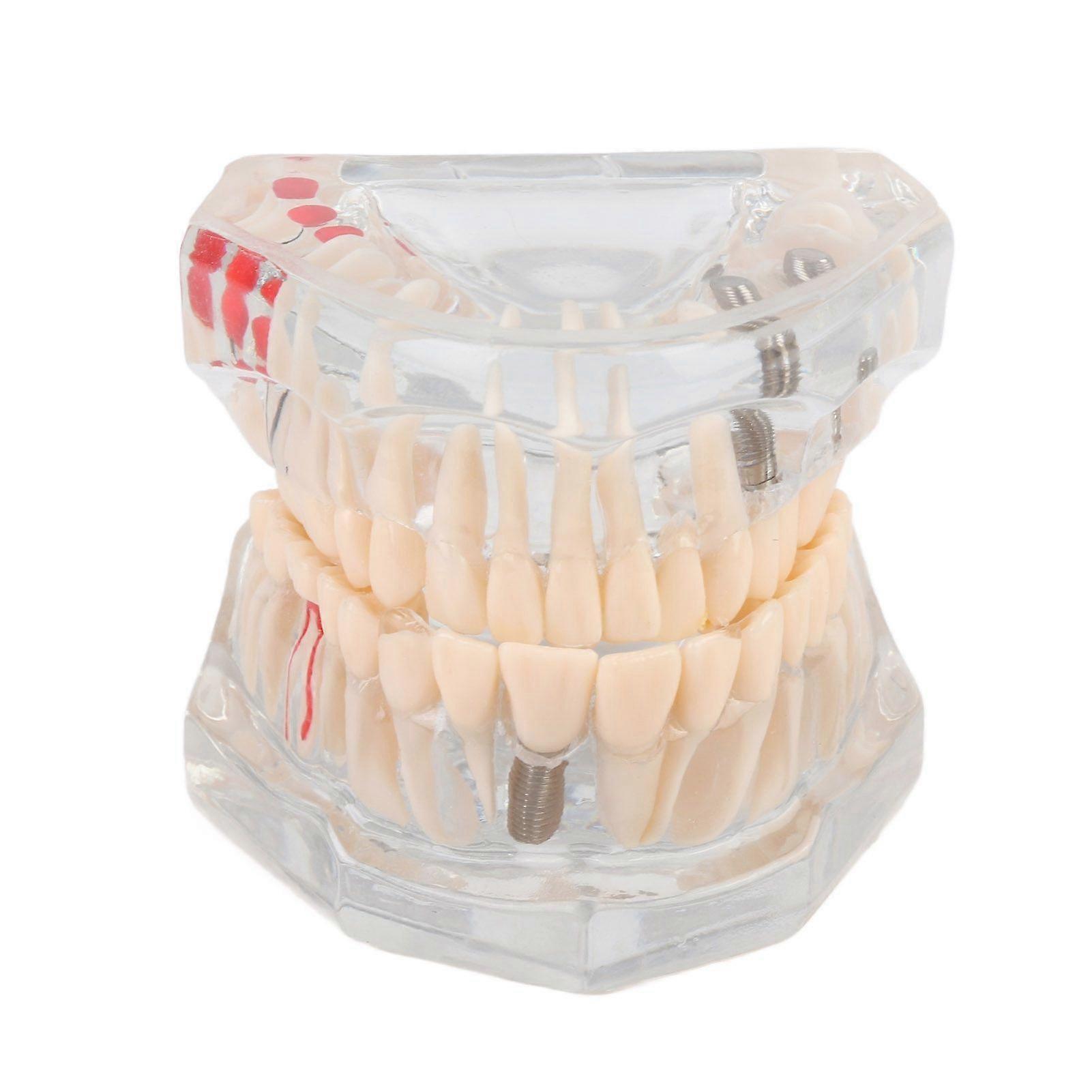 New Dental Teaching Study Standard Tooth Model Demonstration Disease Educational