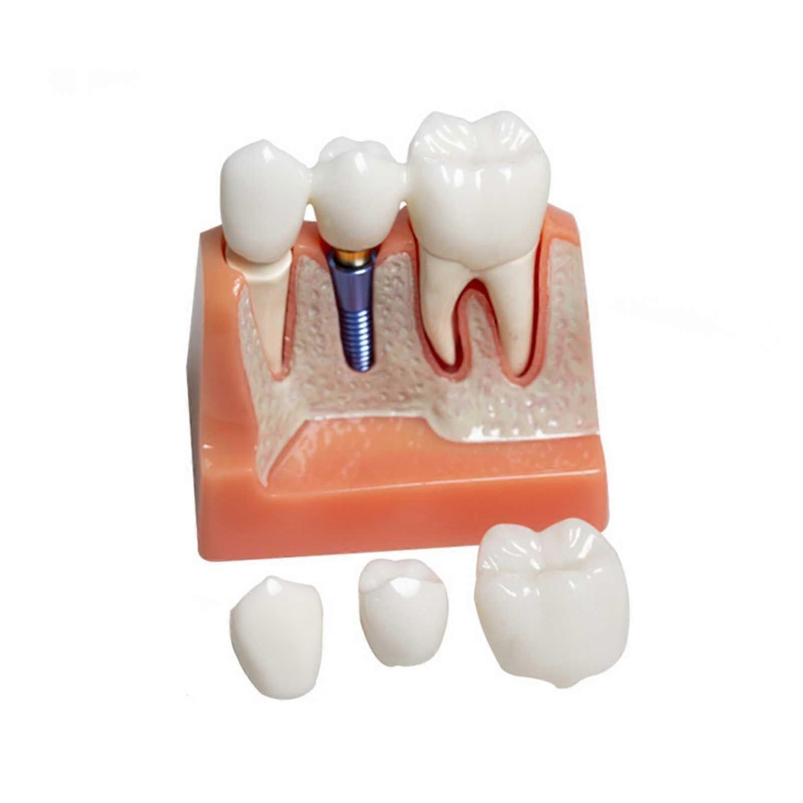Dental Implant Model 4:1 Enlarged Fixed Prosthetic Display for Placement Teaching and Training