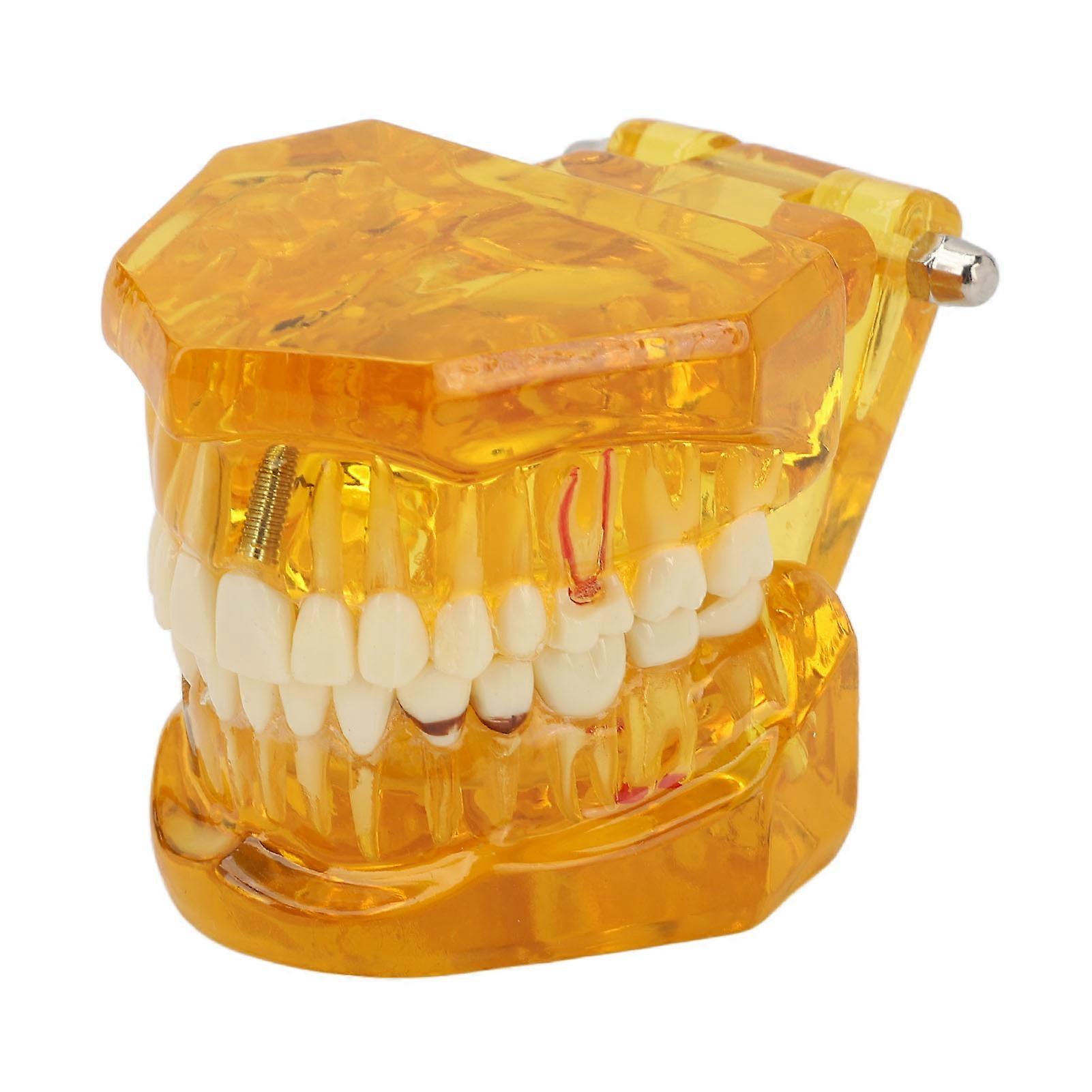 Dental Pathological Model Clear Structure Educational Teeth Display Model Transparent Yellow