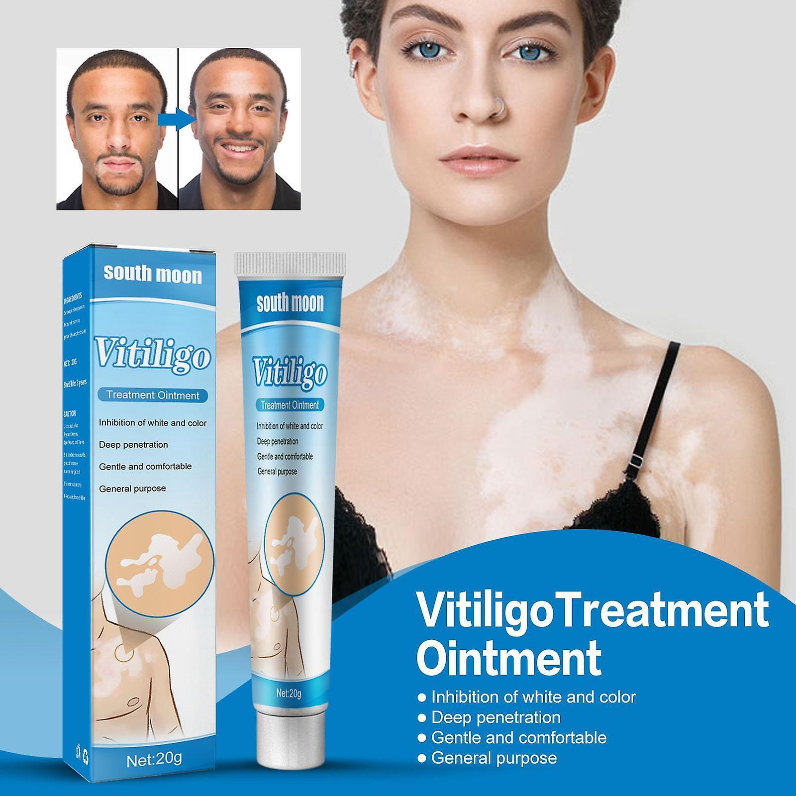 White Spot Treatment Cream Vitiligine Leukoplakia Antibacterial Pigment Relief Come mostrato