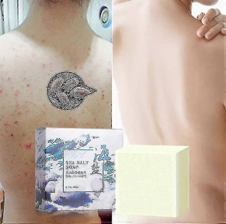 صابون الجلد المضاد للفطريات صابون مضاد للعث صابون مصنوع يدويا صابون ملح البحر Antimite التحكم في الزيت وشد الجلد
