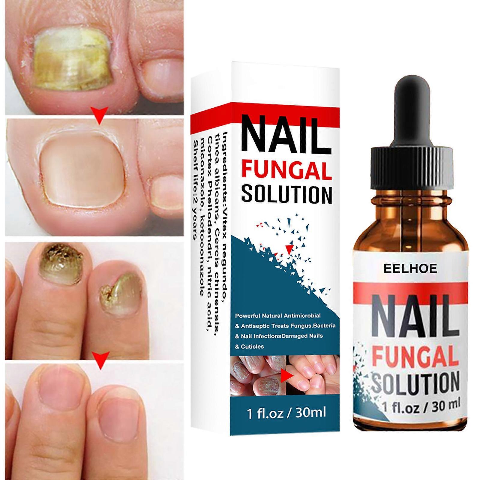 Nail Fungal Solution, Extra Strong Toenail Fungus Nail Treatment, Fungus Fingernail & Toenail Solution to Renew Damaged Discoloured Toenail