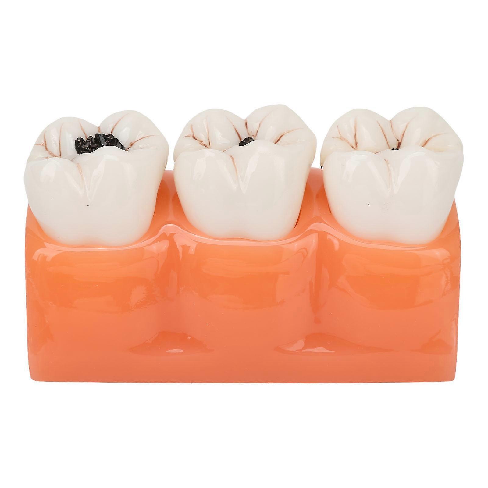 Resin Dental Caries Teeth Model 4 Times Dental Pathology Decayed Tooth Model for Teaching Learning