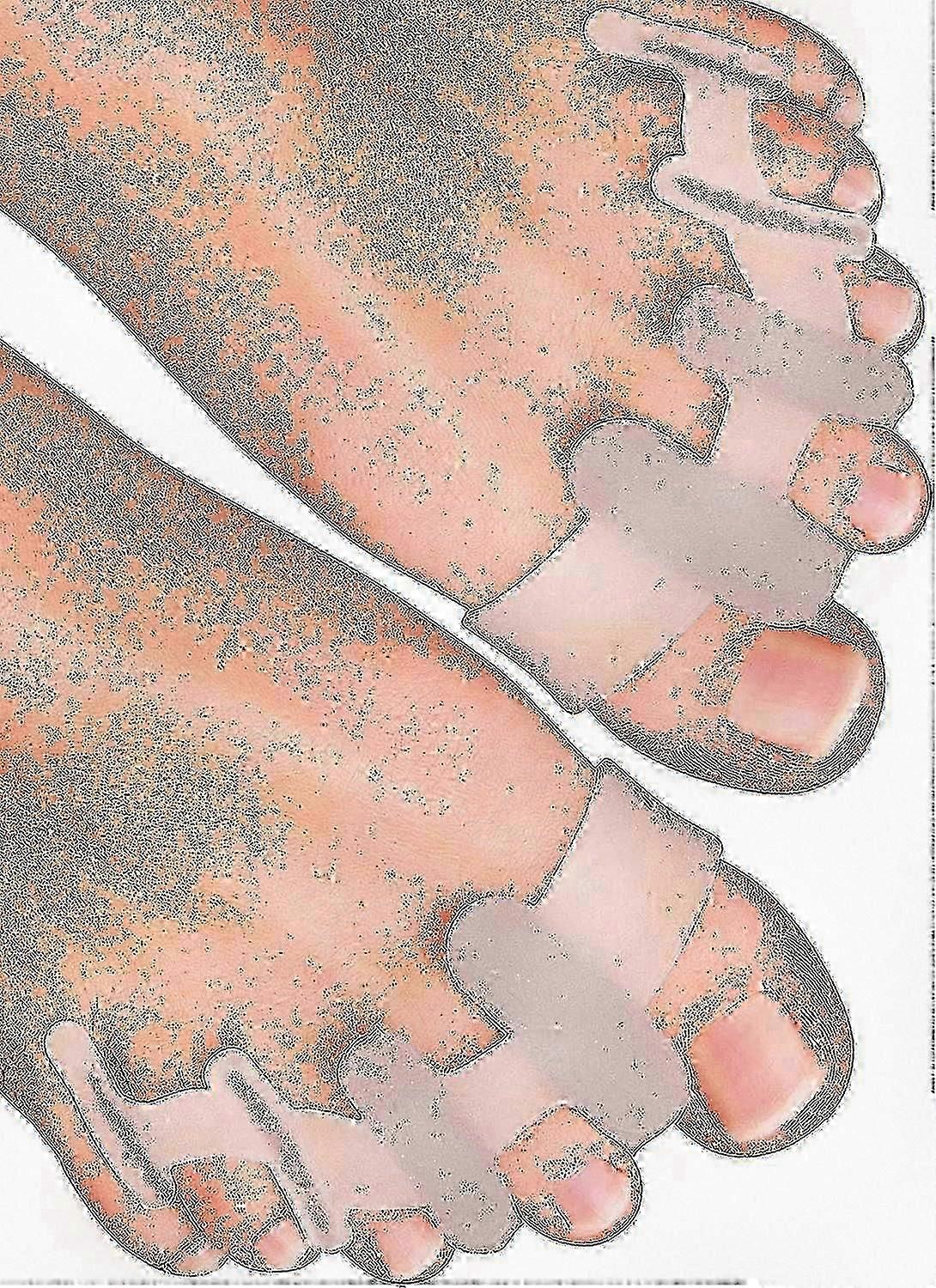 Yogamedic Silicone Toe Separators For Overlapping Toes, Bunion Relief And Alignment, 6-pack, Bpa-free, One Size, Comfortable Stretching And Relaxation