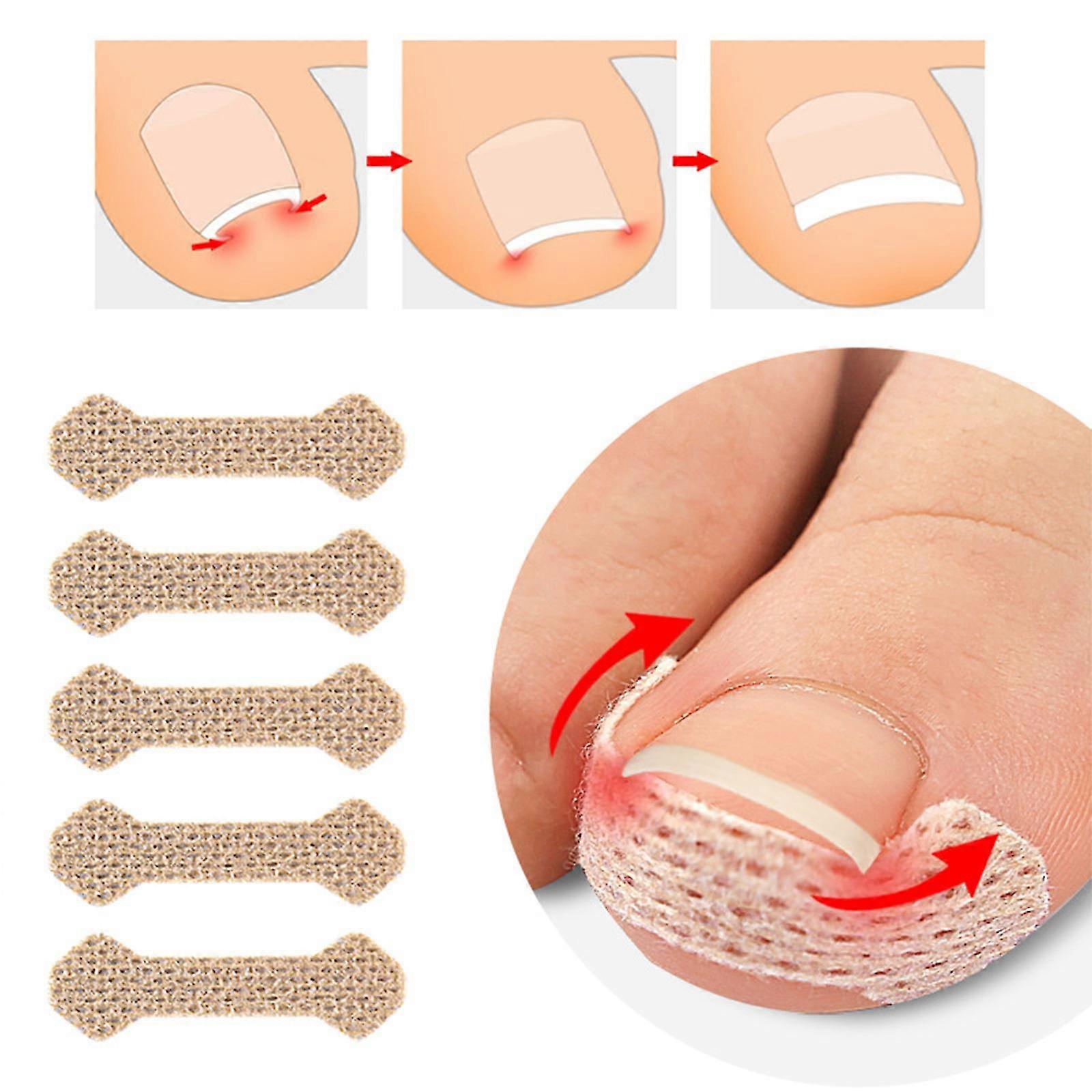 Patch correcteur d’ongles d’orteils, traitement des ongles incarnés, 10 bandes d’ongles incarnés respirantes, outil indolore pour ongles incarnés Tw