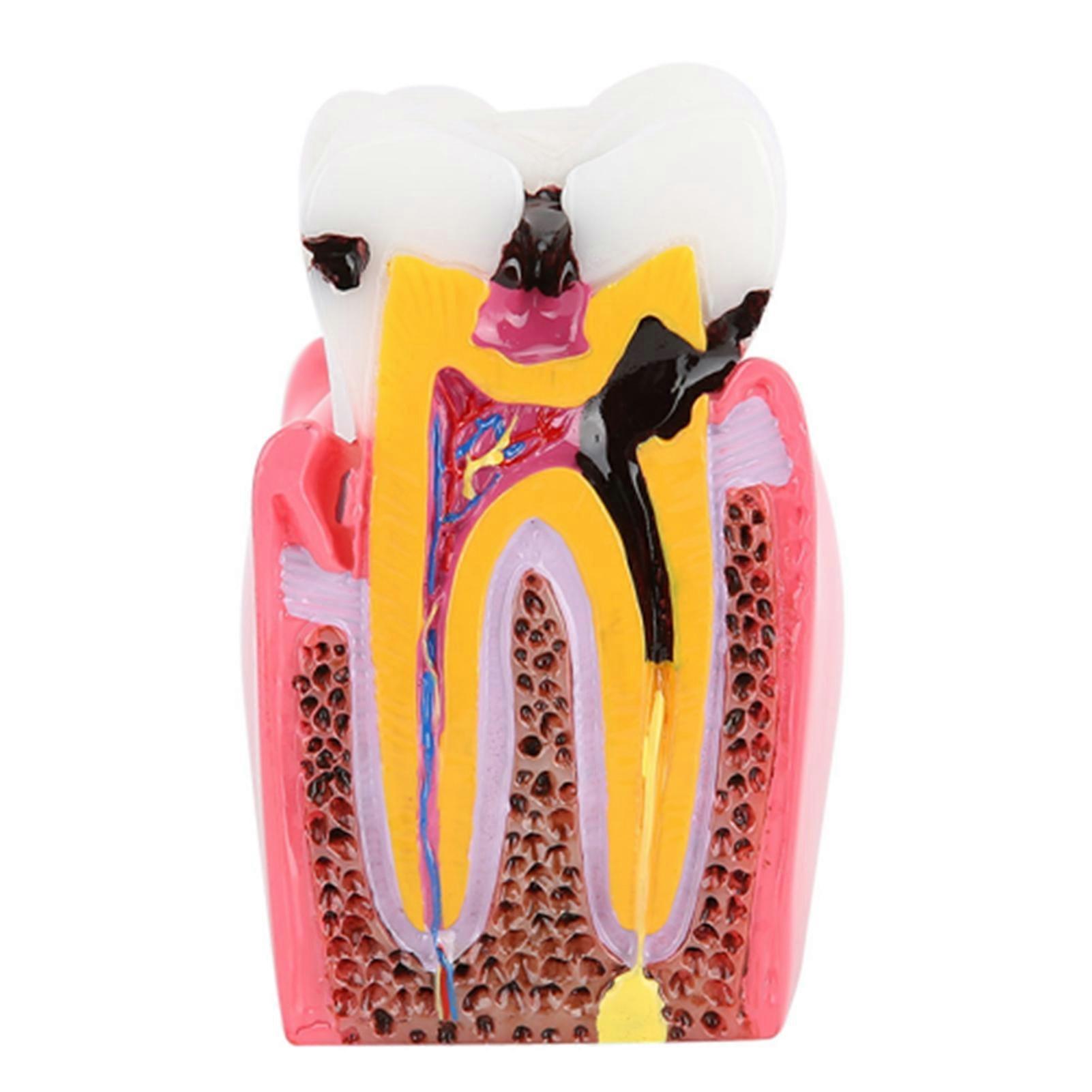 Caries Comparison Study Models Dentist Dental Anatomy Education Teeth Model