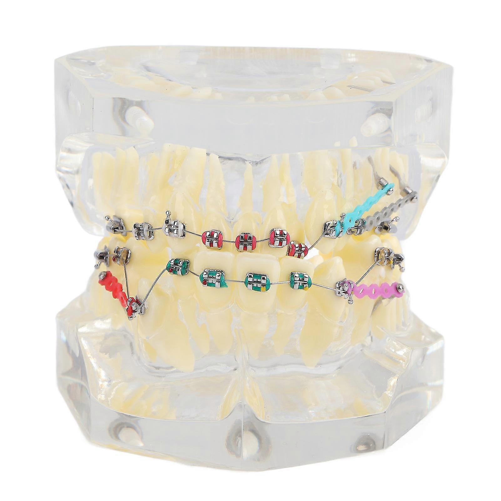 Dental Orthodontic Treatment Malocclusion Study Teeth Model With Wire Chain