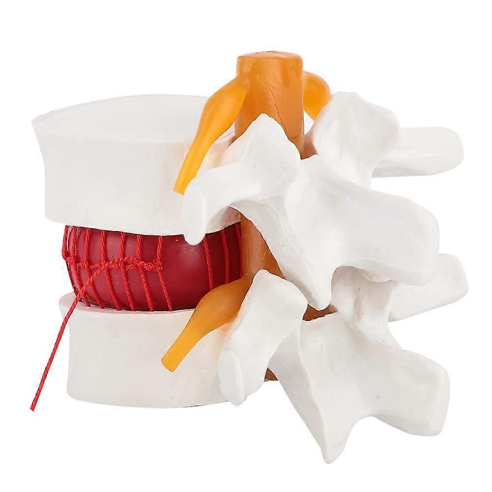 1,5x Lumbar Disc Herniation Model with Human Lumbar Spine Spine Demonstration for Orthopedics and Clinical Teaching