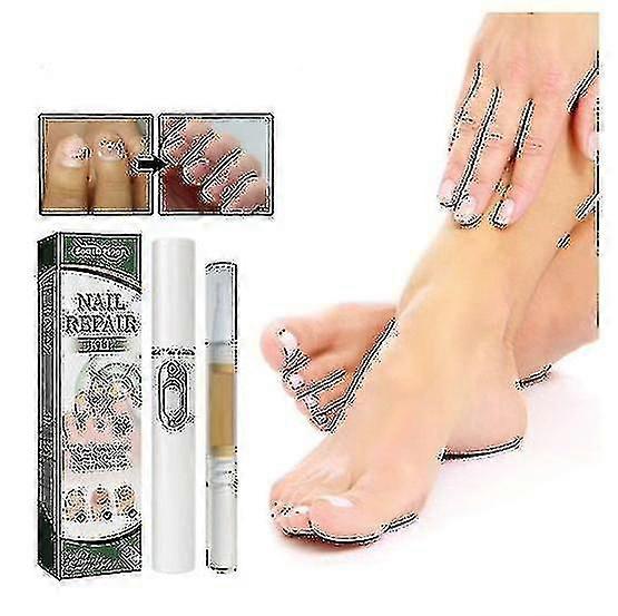 1/3pcs טיפול אנטי פטרייתי אנטי פטרייתי אוניכומיקוזיס פרוניצ'יה פטרייה טיפול בשמן ציפורניים עט מסיר ציפורניים אנטי פטרייתי