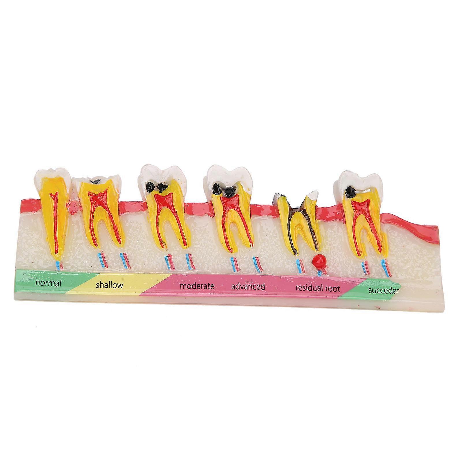 Dental Caries Developing Model Portable Decayed Teeth Model for Dental Teaching Study