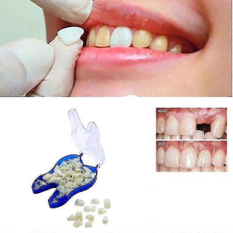 Upper Occluding Temporary Denture Braces Veneer Dentures for Missing Teeth Broken Teeth Tooth Gaps