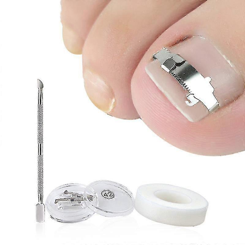 Ingegroeide teennagel tool, ingegroeide teennagel