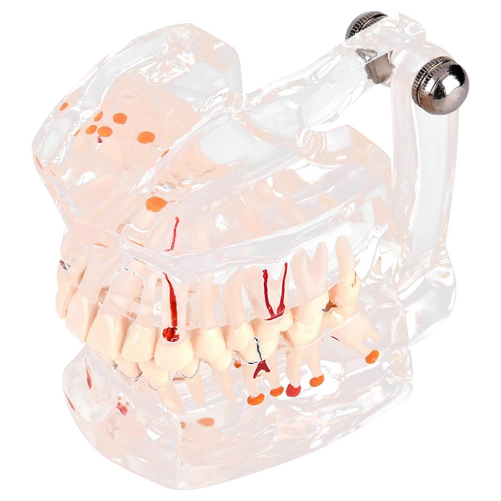 High-Quality Plastic Dental Caries Model with Transparent Gingiva for Teaching and Demonstration
