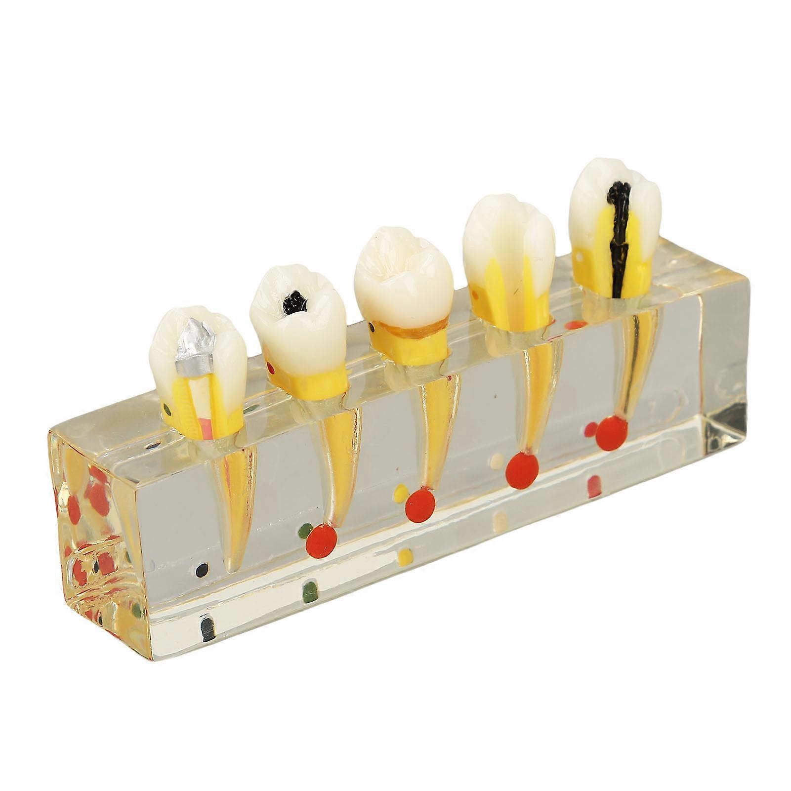 Teeth Model Dental Study Transparent Implant Dental Caries Model for Dental Teaching