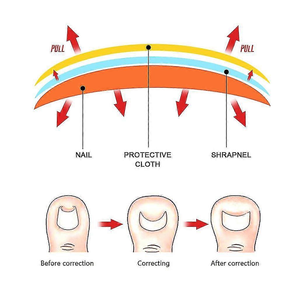 10/50pcs Toenail Correction Sticker Glue Free Corrector Toe Nail Ingrown Patch