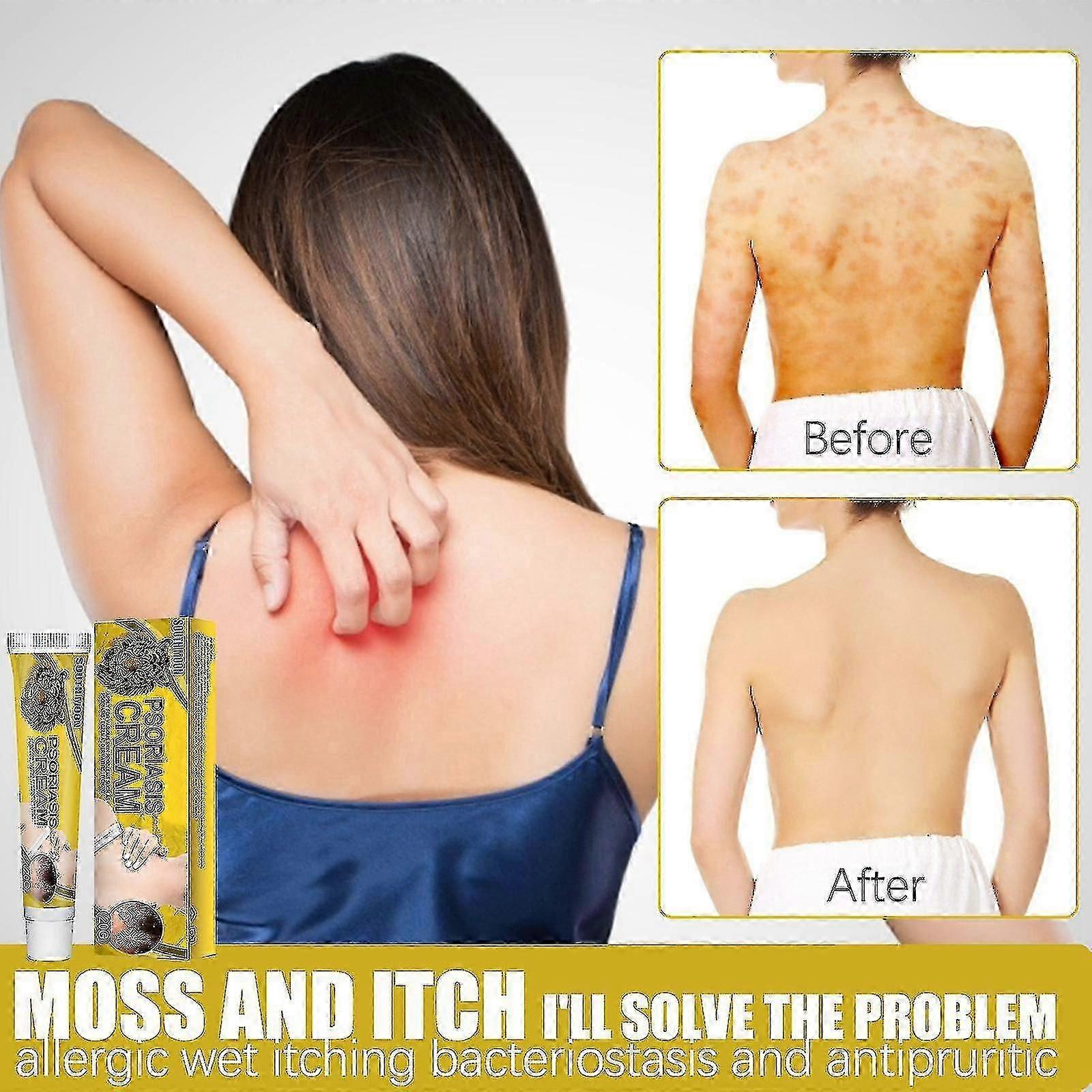 スキンリペアクリーム、Versicolor、スウェットスポット、局所塗布、軟膏、皮膚、かゆみ止め、C