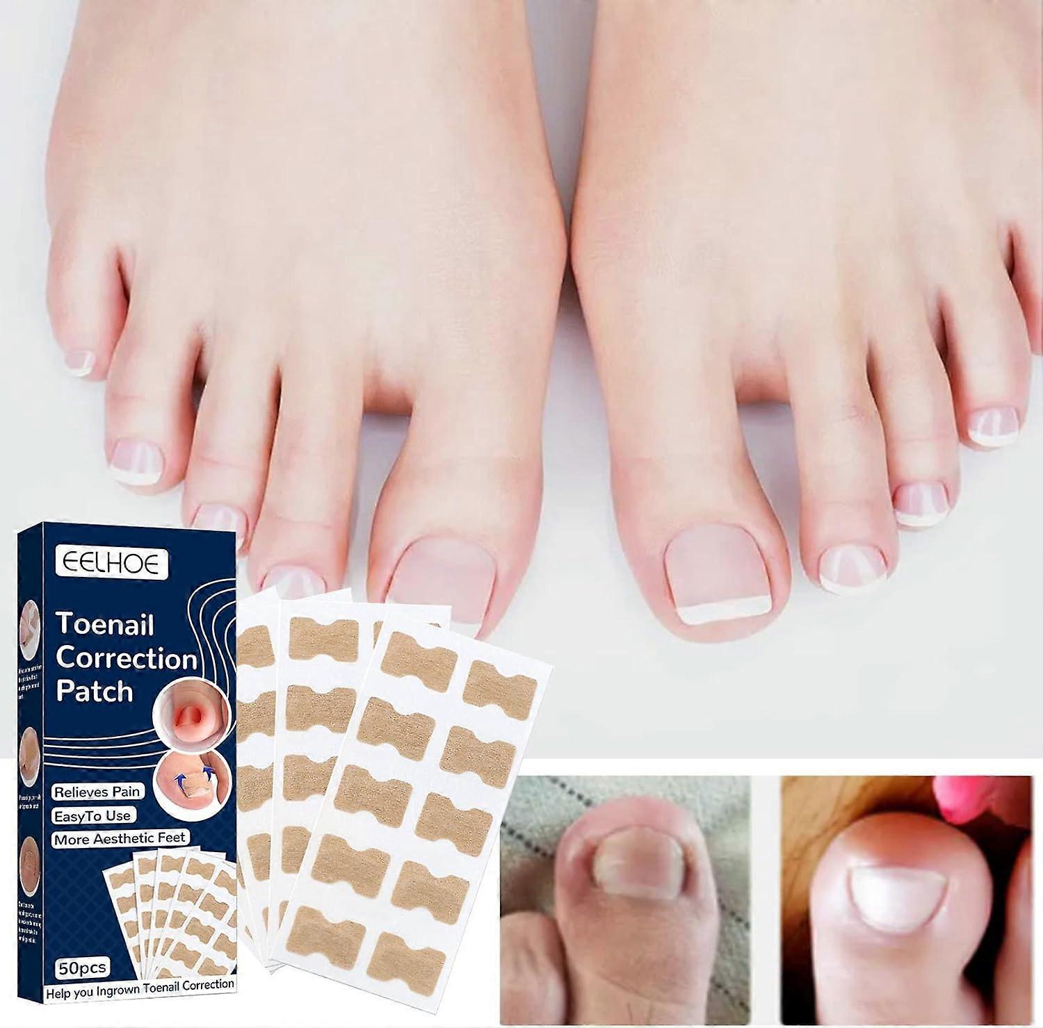50pcs Toenail Correction Stickers, Ingrown Toenail Prevention Stickers, Toenail Infection Correction Stickers